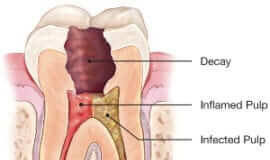 THINGS YOU MUST DO BEFORE YOU PREPARE FOR YOUR ROOT CANAL SURGERY